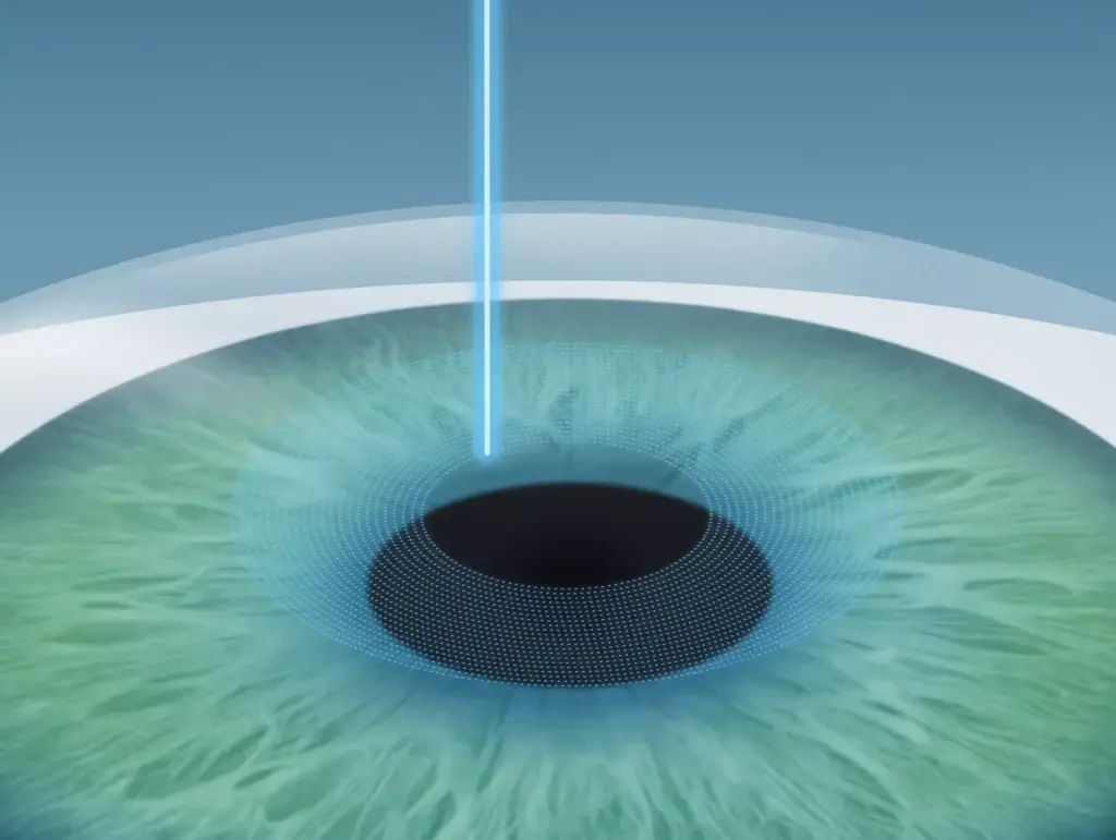 1. Schritt der Femto-Lasik OP | Augenlasern Düsseldorf