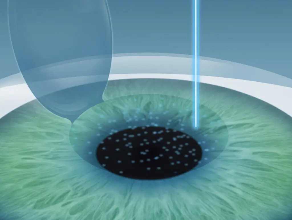 2. Schritt der Femto-Lasik OP | Augenlasern Düsseldorf