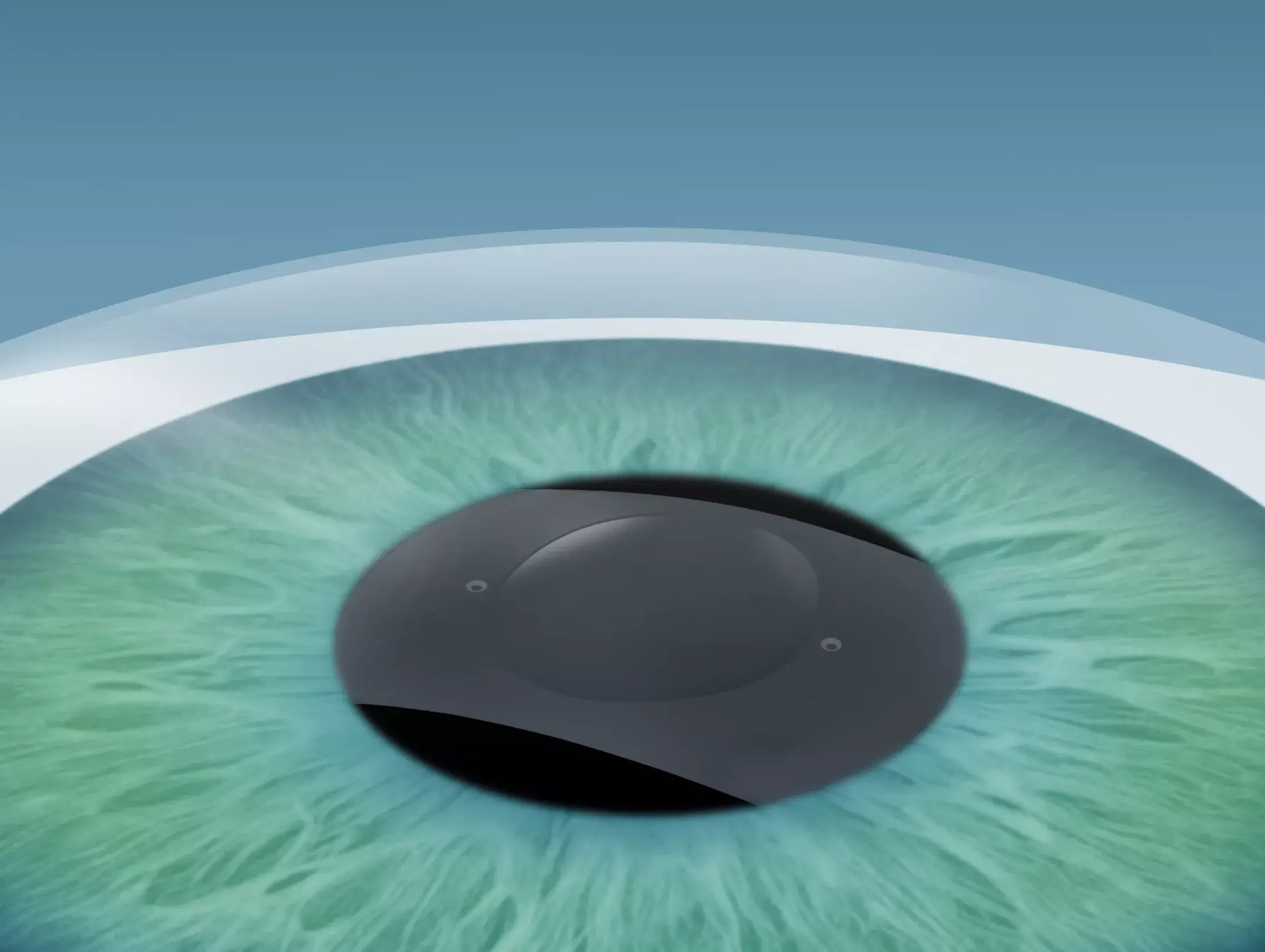 3. Schritt ICL OP - Linsenchirurgie in Düsseldorf und Wuppertal