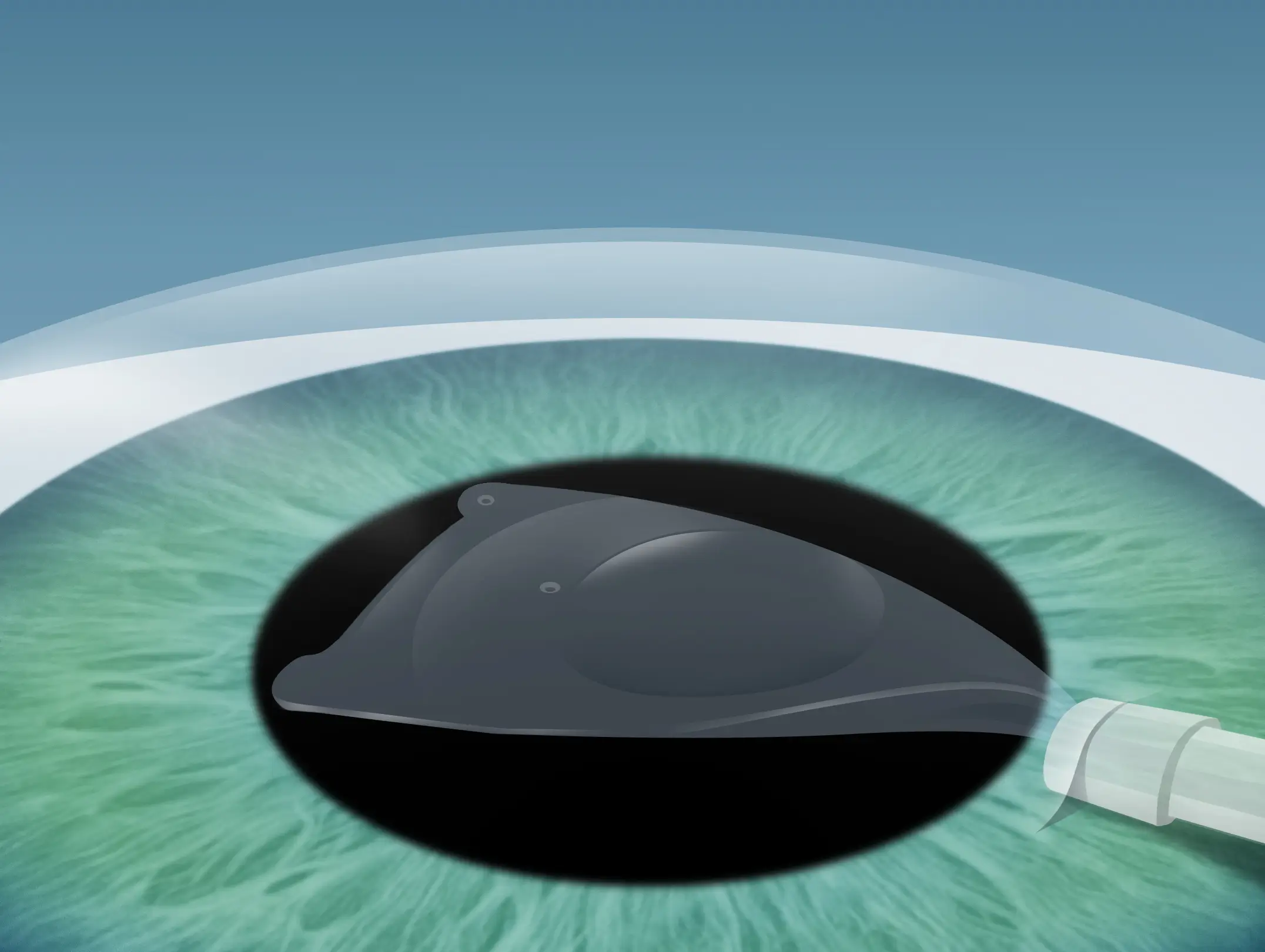 2. Schritt ICL OP - Linsenchirurgie in Düsseldorf und Wuppertal