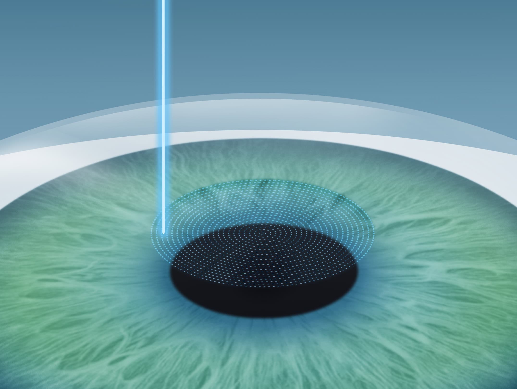 2. Schritt der Trans-PRK OP- Augenlasern für Sportler, sicher und risikoarm